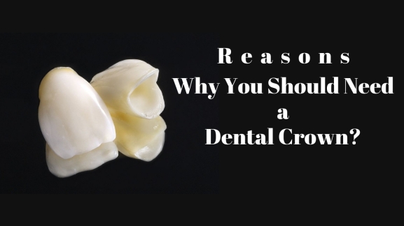 Reasons Why You Should Need a Dental Crown_ (1)